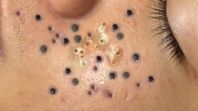Blackhead Removal 3