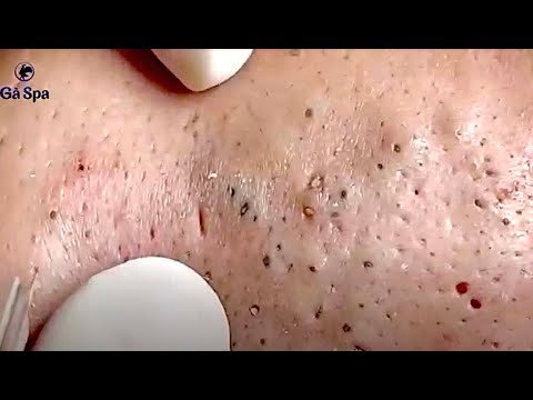 Blackhead Removal 1