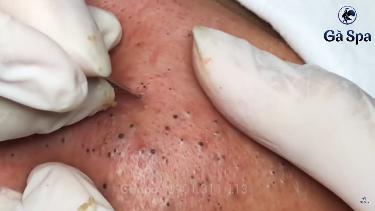 Blackhead Removal
